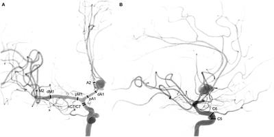 Nimodipine vs. Milrinone – Equal or Complementary Use? A Retrospective Analysis